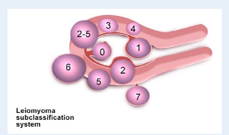 T y p e 0 - T y p e 2 肌 瘤 生 長 在 子 宮 內 ， 又 稱 黏 膜 下 肌 瘤 ； T y p e 3 - T y p e 5 肌 瘤 生 長 在 肌 肉 層 ， 又 稱 為 子 宮 肌 層 肌 瘤 ； T y p e 6 - T y p e 7 肌 瘤 生 長 於 子 宮 外 側 ， 有 些 會 帶 蒂 ， 又 稱 為 漿 膜 下 肌 瘤 ( 出 自 ： 國 際 婦 產 科 聯 盟 ) 