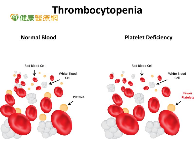 莫名出血點、瘀青！ 免疫性血小板低下症恐腦出血